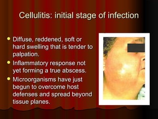 Cellulitis: initial stage of infectionCellulitis: initial stage of infection
 Diffuse, reddened, soft orDiffuse, reddened, soft or
hard swelling that is tender tohard swelling that is tender to
palpation.palpation.
 Inflammatory response notInflammatory response not
yet forming a true abscess.yet forming a true abscess.
 Microorganisms have justMicroorganisms have just
begun to overcome hostbegun to overcome host
defenses and spread beyonddefenses and spread beyond
tissue planes.tissue planes.
 