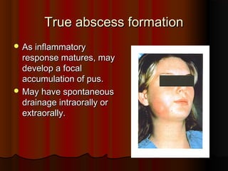 True abscess formationTrue abscess formation
 As inflammatoryAs inflammatory
response matures, mayresponse matures, may
develop a focaldevelop a focal
accumulation of pus.accumulation of pus.
 May have spontaneousMay have spontaneous
drainage intraorally ordrainage intraorally or
extraorally.extraorally.
 