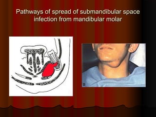 Pathways of spread of submandibular spacePathways of spread of submandibular space
infection from mandibular molarinfection from mandibular molar
 