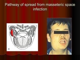 Pathway of spread from masseteric spacePathway of spread from masseteric space
infectioninfection
 