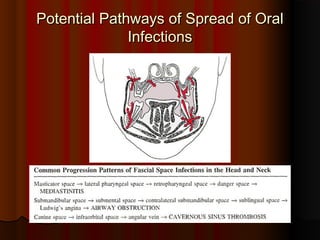 Potential Pathways of Spread of OralPotential Pathways of Spread of Oral
InfectionsInfections
 