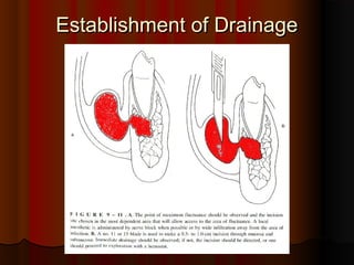 Establishment of DrainageEstablishment of Drainage
 