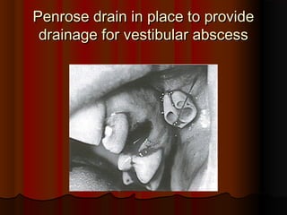 Penrose drain in place to providePenrose drain in place to provide
drainage for vestibular abscessdrainage for vestibular abscess
 