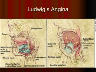 Ludwig’s AnginaLudwig’s Angina
 