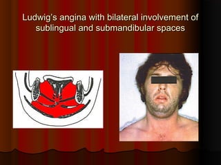 Ludwig’s angina with bilateral involvement ofLudwig’s angina with bilateral involvement of
sublingual and submandibular spacessublingual and submandibular spaces
 