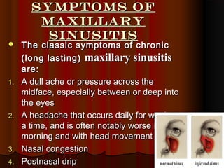 Symptoms ofSymptoms of
maxillarymaxillary
SinusitisSinusitis
 The classic symptoms of chronicThe classic symptoms of chronic
(long lasting)(long lasting) maxillary sinusitismaxillary sinusitis
are:are:
1.1. A dull ache or pressure across theA dull ache or pressure across the
midface, especially between or deep intomidface, especially between or deep into
the eyesthe eyes
2.2. A headache that occurs daily for weeks atA headache that occurs daily for weeks at
a time, and is often notably worse in thea time, and is often notably worse in the
morning and with head movementmorning and with head movement
3.3. Nasal congestionNasal congestion
4.4. Postnasal dripPostnasal drip
 