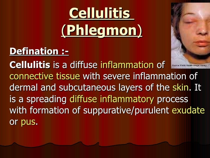 Tooth Abscess: Treatment, Remedy, Pictures, Symptoms and ...