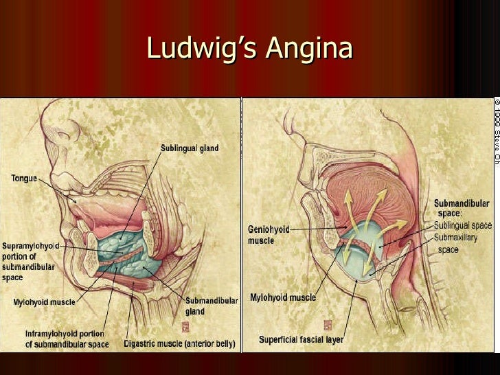 ludwig s angina