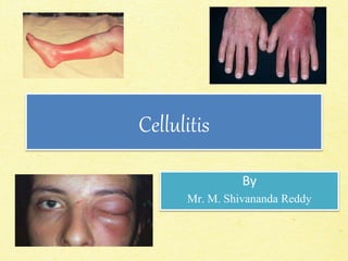Cellulitis
By
Mr. M. Shivananda Reddy
 