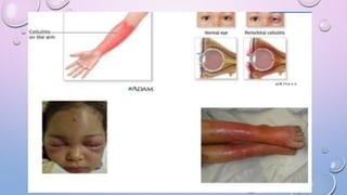 Cellulitis Lettering Cellulitis | PPTX