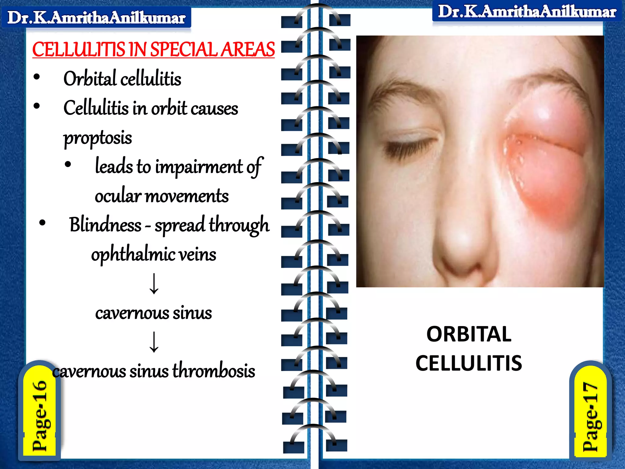 Cellulitis by Dr.K.AmrithaAnilkumar | PPTX