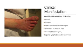 Clinical
Manifestation
CLINICAL HALLMARKS OF CELLULITIS
•Warmth.
•Erythema.
•Edema with nonpalpable margins.
•Tenderness of affected area,
•Associated lymphangitis,
•Regional lymphadenopathy and Fever.
 