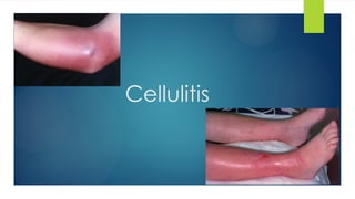 Progressive Cellulitis an Aprouch to examination towards Cellulitis.pptx