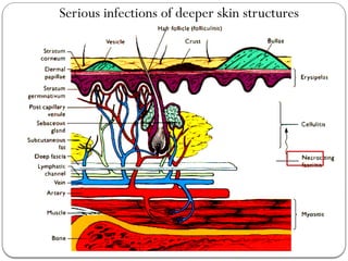 Comprehensive Overview of Cellulitis: Causes, Symptoms, and Treatment ...