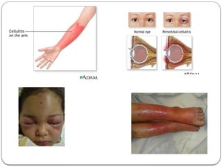 Cellulitis In Tagalog Comprehensive Overview of Cellulitis: Causes, Symptoms, and Treatment ...