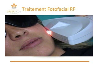Traitement Fotofacial RF 