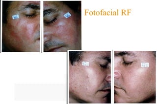 Fotofacial RF 