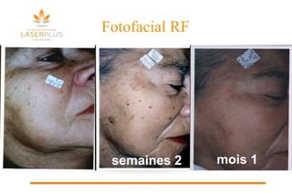 Fotofacial RF 2 semaines 1 mois 