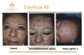 1 mois après Avant Immédiatement après Fotofacial RF 