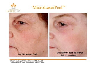 Pre MicroLaserPeel One Month post 40 Micron MicroLaserPeel Photo’s courtesy of Jeffrey M. Kenkel, M.D., F.A.C.S The University of Texas Southwestern Medical Center MicroLaserPeel ™ 