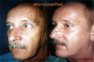 MicroLaserPeel Photo:  Patient of Roy S. Winston, M.D., The Plastic Surgery Institute of Rancho Mirage, CA 7 jours après le 2e Traitement de  40  microns 