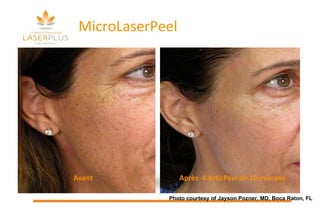 MicroLaserPeel Photo courtesy of Jayson Pozner, MD, Boca Raton, FL Avant  Après  4 ArticPeel de 10 microns 