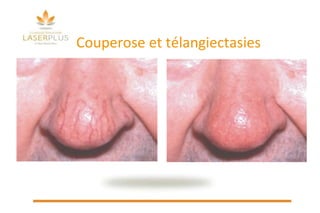 Couperose et télangiectasies 