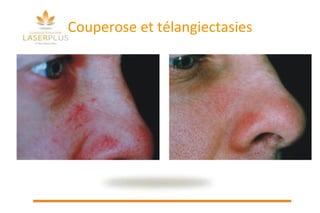 Couperose et télangiectasies 