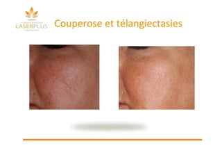 Couperose et télangiectasies 