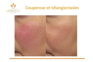 Couperose et télangiectasies 