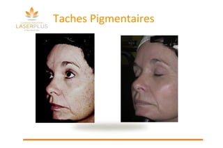 Taches Pigmentaires 