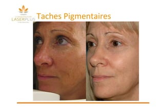 Taches Pigmentaires 