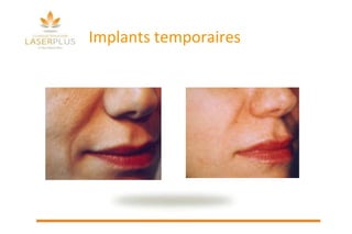 Implants temporaires                     