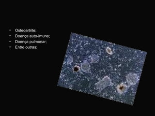 Osteoartrite; Doença auto-imune;  Doença pulmonar;  Entre outras; 