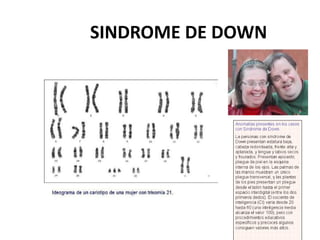 SINDROME DE DOWN
 
