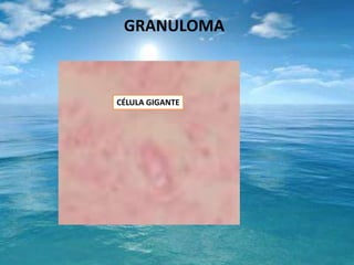 GRANULOMACÉLULA GIGANTE