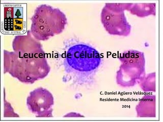 Leucemia de Células Peludas 
C. Daniel Agüero Velásquez 
Residente Medicina Interna 
2014 
 