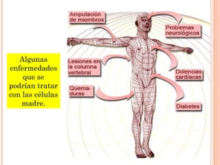 Algunas
enfermedades
que se
podrían tratar
con las células
madre.
 