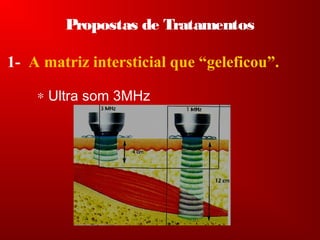 Propostas de Tratamentos
1- A matriz intersticial que “geleficou”.
∗ Ultra som 3MHz
 