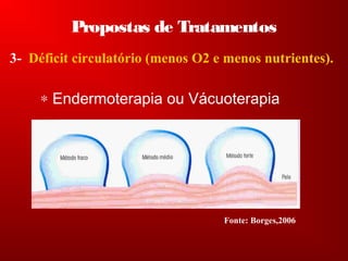 Propostas de Tratamentos
3- Déficit circulatório (menos O2 e menos nutrientes).
∗ Endermoterapia ou Vácuoterapia
Fonte: Borges,2006
 