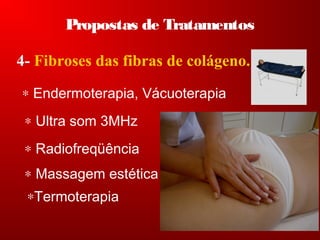 Propostas de Tratamentos
4- Fibroses das fibras de colágeno.
∗ Endermoterapia, Vácuoterapia
∗ Ultra som 3MHz
∗ Radiofreqüência
∗ Massagem estética
∗Termoterapia
 