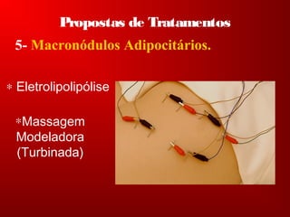 Propostas de Tratamentos
5- Macronódulos Adipocitários.
∗Massagem
Modeladora
(Turbinada)
∗ Eletrolipolipólise
 