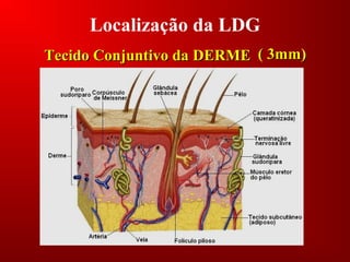 Localização da LDG
Tecido Conjuntivo da DERMETecido Conjuntivo da DERME ( 3mm)( 3mm)
 