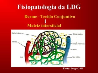 Fisiopatologia da LDG
Derme –Tecido Conjuntivo
Matriz intersticial
Fonte: Borges,2006
 