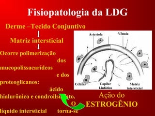 Fisiopatologia da LDG
Ocorre polimerização
dos
mucopolissacarídeos
e dos
proteoglicanos:
ácido
hialurônico e condroilsulfato.
O
líquido intersticial torna-se
Matriz
intersticial
Capilar
Linfático
Arteríola Vênula
Células
Derme –Tecido Conjuntivo
Matriz intersticial
Ação do
ESTROGÊNIO
 