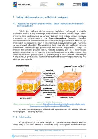 2
Kurs: Zasady wykonywania zabiegów na ciało
7 Zabiegi pielęgnacyjne przy cellulicie i rozstępach
7.1 Rozpoznanie na podstawie obserwacji i badań termograficznych stadiów
rozwoju cellulitu
Cellulit jest efektem niedostatecznego wydalania końcowych produktów
przemiany materii, a więc wadliwego funkcjonowania układu limfatycznego. Główną
przyczyną jego występowania są hormony żeńskie, czyli wyższy poziom estrogenu
w stosunku do progesteronu – tzw. hyperestrogenizm. Estrogeny powodują
rozszerzenie naczyń krwionośnych i zwiększenie ich przepuszczalności. Efektem tego
procesu jest gromadzenie się limfy w przestrzeniach międzykomórkowych i tworzenie
się miejscowych obrzęków. Nagromadzona limfa rozpycha się, uciskając naczynia
krwionośne, uniemożliwiając prawidłowy metabolizm adipocytów. Dlatego też
problem ten dotyczy głównie kobiet. Ponadto związany jest on z zaburzeniami
układów: pokarmowego, nerwowego, krążenia, hormonalnego, a także związany jest
z uwarunkowaniami genetycznymi. To geny decydują o ilości komórek tłuszczowych
w organizmie, o gromadzeniu tłuszczu w komórkach tłuszczowych (adipocytach) oraz
o tempie jego spalania.
Rysunek 7.1 Cellulit – budowa skóry
Źródło: opracowanie własne na podstawie: http://thumbs.dreamstime.com/z/formation-cellulite-vector-
diagram-occurs-most-females-rarely-males-34935527.jpg
Na podstawie najnowszych badań tkanek wyodrębniono dwa rodzaje cellulitu:
wodny (miękki) i lipidowy (twardy).
7.1.1 Cellulit wodny
Występuje najczęściej u osób szczupłych z powodu nieprawidłowego krążenia
krwi i limfy w tkankach, a także w efekcie złej diety i wystąpienia nieprawidłowości
 