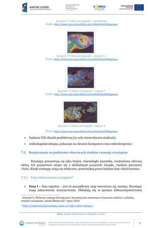 5
Kurs: Zasady wykonywania zabiegów na ciało
Rysunek 7.3 Obraz termografii – prawidłowy
Źródło: http://www.vip-antycellulit.com/cellulit.html#diagnoza
Rysunek 7.4 Obraz termografii – stopień 1-2
Źródło: http://www.vip-antycellulit.com/cellulit.html#diagnoza
Rysunek 7.5 Obraz termografii – stopień 3
Źródło: http://www.vip-antycellulit.com/cellulit.html#diagnoza
Rysunek 7.6 Obraz termografii – stopień 4
Źródło: http://www.vip-antycellulit.com/cellulit.html#diagnoza
badania USG tkanki podskórnej (w celu stwierdzenia stadium);
wideokapilaroskopia, pokazuje na ekranie komputera stan mikrokrążenia3.
7.2 Rozpoznanie na podstawie obserwacji stadiów rozwoju rozstępów
Rozstępy prezentują się jako linijne, równoległe pasemka, rozdzielone zdrową
skórą. Ich pojawienie wiąże się z delikatnym uczuciem świądu, rzadziej pieczenia
i bólu. Kiedy rozstępy stają się widoczne, przechodzą przez kolejne fazy różnicowania.
7.2.1 Fazy różnicowania rozstępów4
Faza I – faza zapalna – jest to początkowy etap tworzenia się zmiany. Rozstępy
mają zabarwienie sinoczerwone. Układają się w postaci kilkucentymetrowej
3 Głuszek S., Wybrane zabiegi chirurgiczne i kosmetyczne stosowane w leczeniu otyłości i cellulitu,
artykuł czasopisma „Studia Medyczne”, lipiec 2010
4 http://tarkiewicz.pl/rozstepy-czym-sa-i-jak-z-nimi-walczyc/
 
