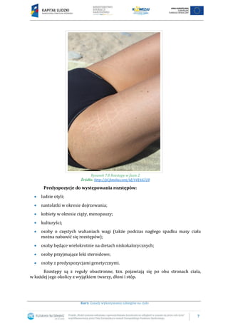 7
Kurs: Zasady wykonywania zabiegów na ciało
Rysunek 7.8 Rozstępy w fazie 2
Źródło: http://pl.fotolia.com/id/44166310
Predyspozycje do występowania rozstępów:
ludzie otyli;
nastolatki w okresie dojrzewania;
kobiety w okresie ciąży, menopauzy;
kulturyści;
osoby o częstych wahaniach wagi (także podczas nagłego spadku masy ciała
można nabawić się rozstępów);
osoby będące wielokrotnie na dietach niskokalorycznych;
osoby przyjmujące leki steroidowe;
osoby z predyspozycjami genetycznymi.
Rozstępy są z reguły obustronne, tzn. pojawiają się po obu stronach ciała,
w każdej jego okolicy z wyjątkiem twarzy, dłoni i stóp.
 
