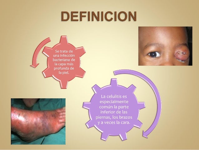 Celulitis Infecciosa