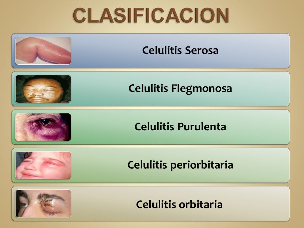 Celulitis Infecciosa